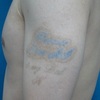 刺青  入れ墨  タトゥー　　５年間のレーザー治療を行った後に植皮手術を行った症例