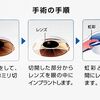 視力回復のための選択肢、ICL手術とは