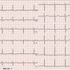 ECG-201：90才代女性。布団を敷いていて、失神しました。