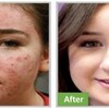 How To Use Acne Face Mask To Get Clear And Glowing Skin?