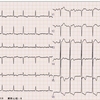 ECG-145:93才女性。ERで記録した心電図です。