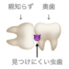 下の親知らずを一本抜いてきたので体験談をまとめてみる