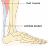 The Primary Causes And Therapies Of Achilles Tendonitis