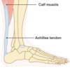 Achilles Tendinitis 