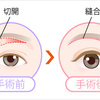 眉下切開（眉下リフト）で上まぶたのたるみを解消！