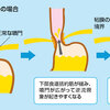 歳をとれば皆、逆流性食道炎？