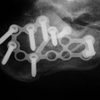 What Is A Posterior Calcaneal Spur