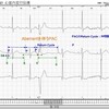 悩ましいのは変行伝導～AB・C（ABerrant・Conduction）を考える