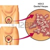 性器ヘルペスの発症が少なくなった　新宿
