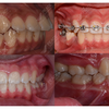 Răng hô vẩu là gì? Phương pháp khắc phục răng hô?