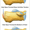 The Right Way To Identify Posterior Calcaneal Spur