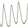 ECG-171：60才代男性。昨夜からの高熱と頻脈です。