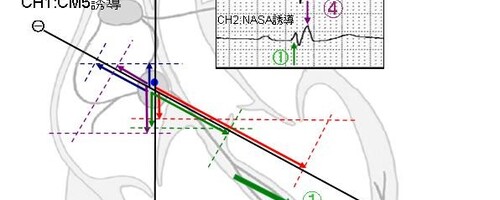 QRS波形をベクトルで読み解く　その3　右脚ブロック波形