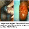 Ciri Ciri Terkena Sipilis Pada Pria dan Wanita