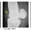 第三中手骨矢状稜遠位のOCDの同定および治療（Wrightら2014）