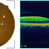 OCT検査の実例