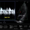 心エコー。連続の式で僧帽弁口面積を測ってみよう！。連続の式による弁口面積の計測。