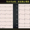 ECG-238：70才代女性。II, III, aVFの異常Q波ですが。。