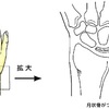 手首の痛みの原因となる「キーンベック病」について整形外科医が解説してみました