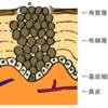 いぼ（尋常性疣贅）のメカニズム