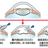 白内障：嚢外摘出術と嚢内摘出術の違い