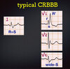 【コラム-098】CRBBBについて あなたに知って欲しいこと