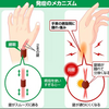 手首の腱鞘炎を見極める方法。