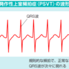 PSVTへの対応