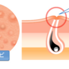 ニキビの種類