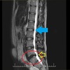 腰椎椎間板ヘルニア手術　手術前ヘルニアのMRI画像