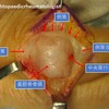 イラストよりわかるボタン穴変形の実際の解剖ーー実際の術中写真より　the most impressive photograph of boutonniere deformity