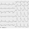 ECG-132：80才女性。突然の胸痛発作で、ERヘ搬入。