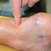 Physical Therapy For Achilles Tendon Rupture Surgery Or Not