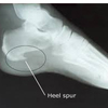 The Right Way To Identify Inferior Calcaneal Spur