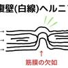 【生後10ヶ月】臍ヘルニアじゃなく腹壁ヘルニア？今後の治療方針を聞いてきました。