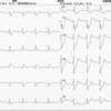 ECG-100：75才男性。クリスマスの胸痛発作です。