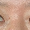 【眼瞼下垂手術】70日目　検診結果