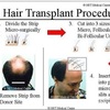 Does Hair Transplant Work Out to be a Better Choice