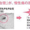 原因不明のしつこい痛み　「もやもや血管」が原因かも