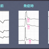 ECG-057：answer