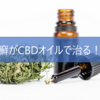 CBDオイルで乾癬が治る！？倦怠気味の乾癬治療法に新しい光が