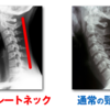 ストレートネックになると起こりやすいこと