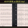ECG-255：60才代男性。胸部不快発作と動悸です。