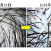 頭皮チェック！私の頭皮のマイクロスコープ写真公開！