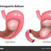 胃内バルーン　当日