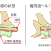 頚椎ヘルニア治療記③　再発 MRI & CT