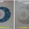 背中の濃いタトゥーをエンライトンⅢで薄くしています