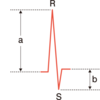 QRS低電位差の定義と原因