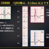 ECG-306：answer