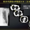 ECG-237：80才代男性。呼吸苦での来院でした。